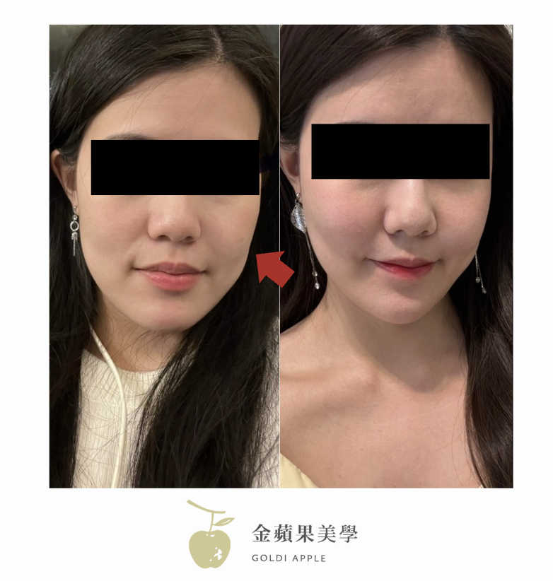 臉頰凹陷醫美
